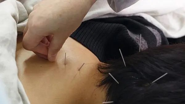 首・肩のこりや痛みに悩まないで！ 鍼灸とマッサージで快適な生活を